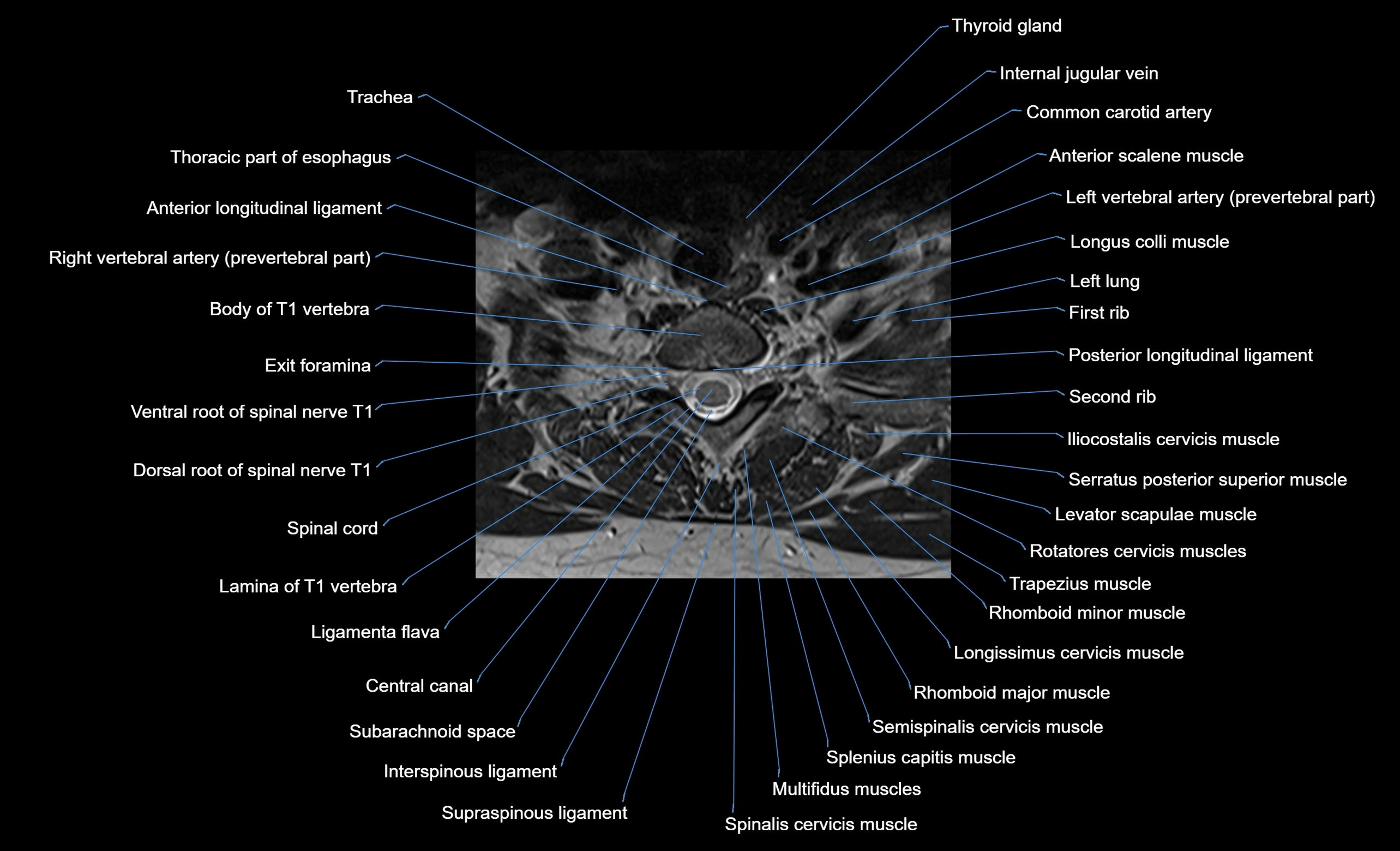cervical spine cross sectional MRI anatomy  3T MRI axial  image-img-00001-00042.webp